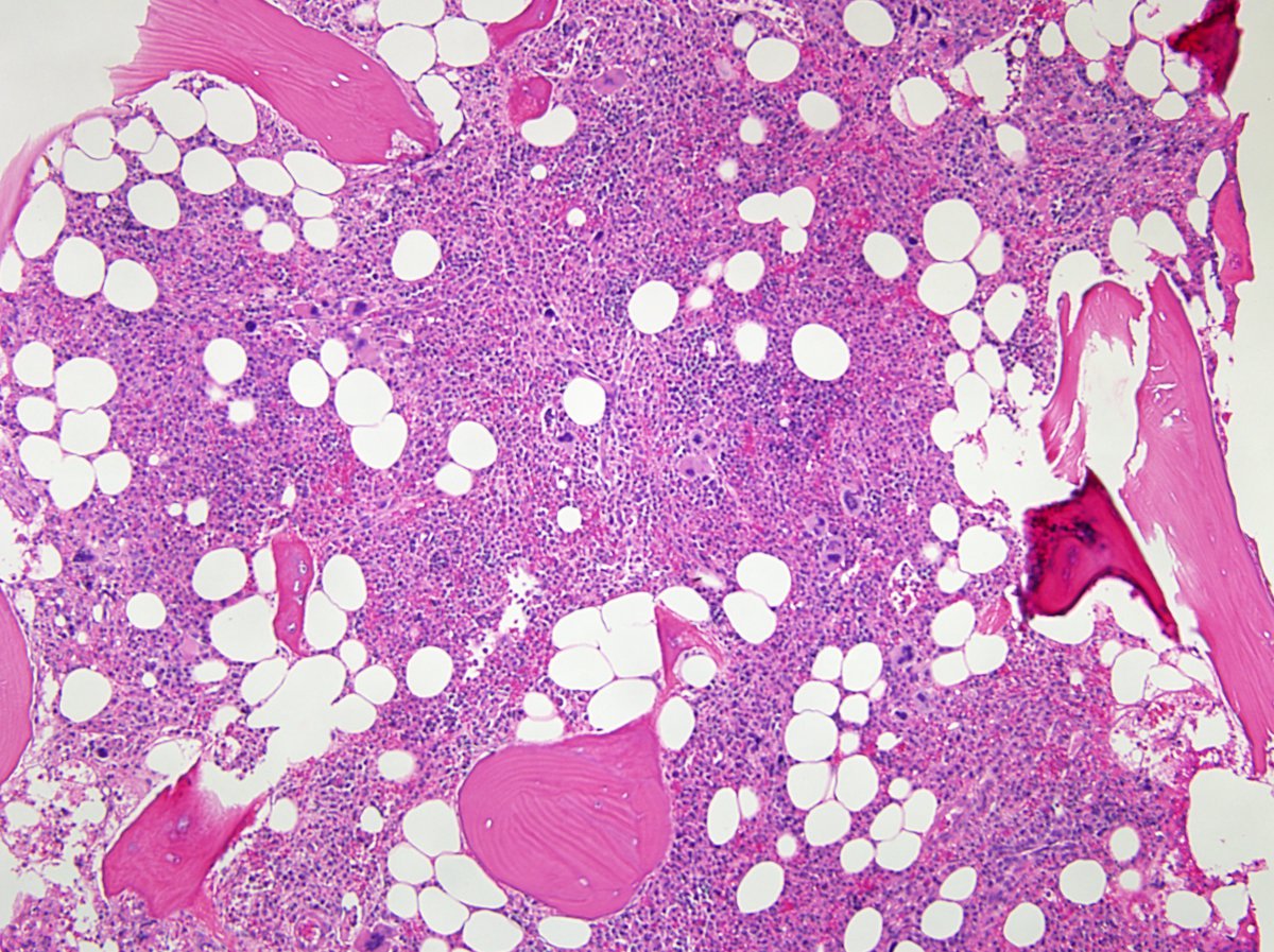 Hypercellular marrow showing panmyelosis c/w PV